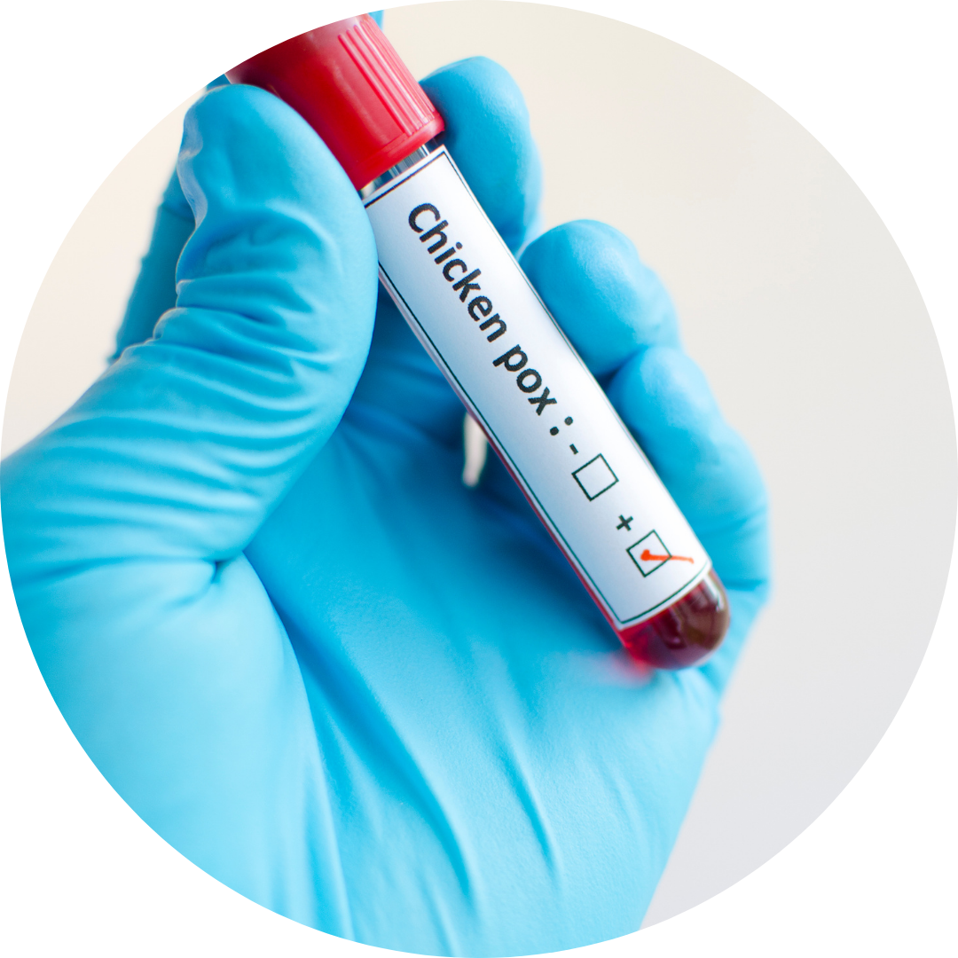 Chickenpox Treatment in Wales