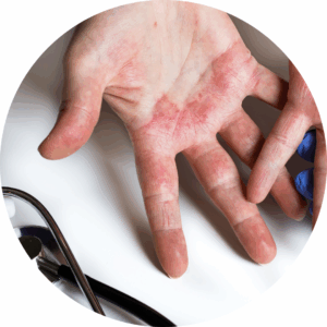 Dermatitis Treatment in Wales