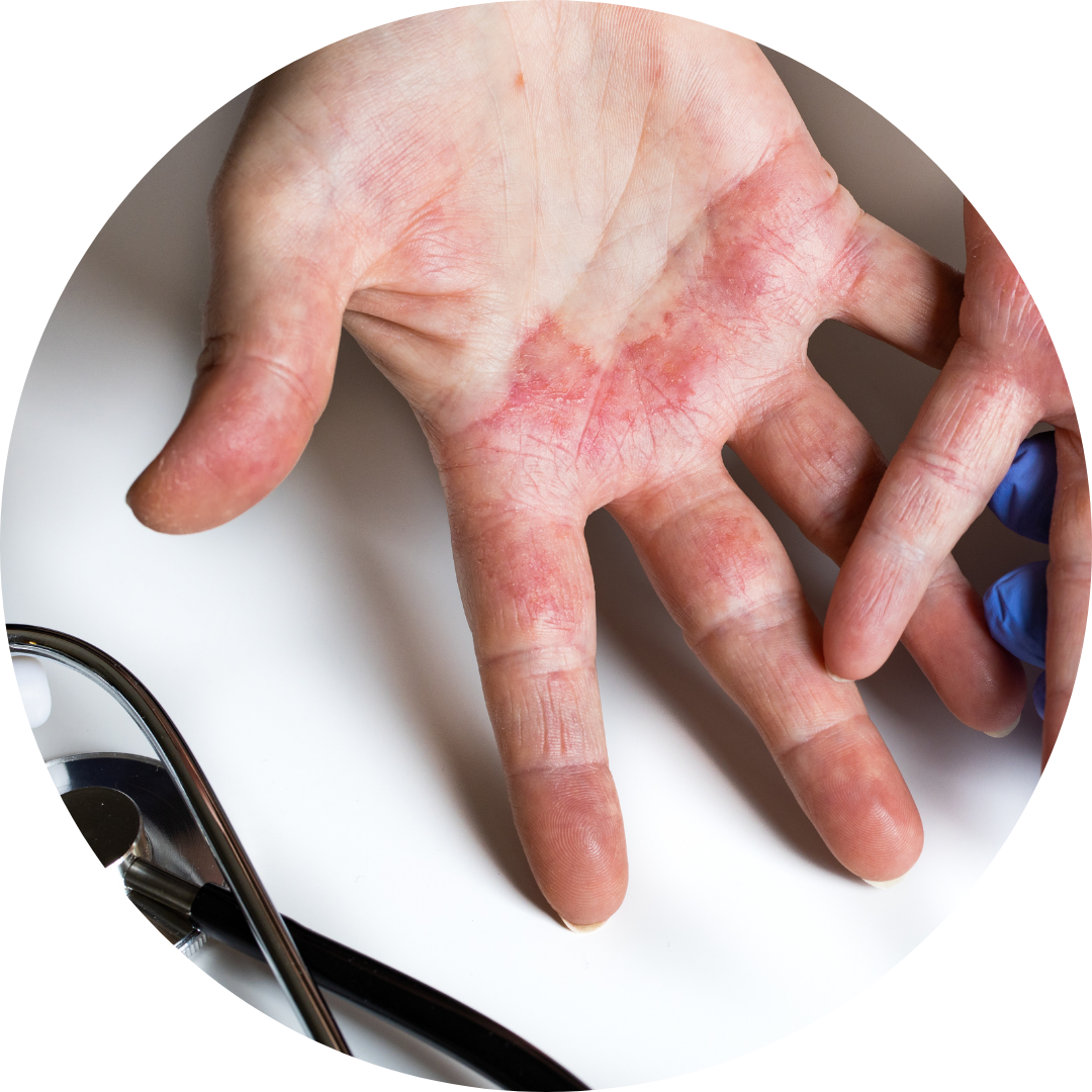 Dermatitis Treatment in Wales