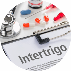 Intertrigo treatment in Wales
