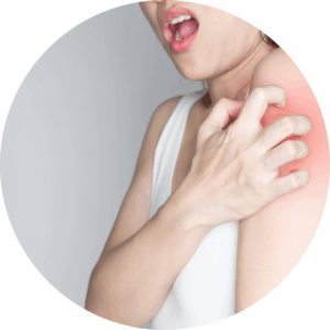 Scabies treatment in Wales